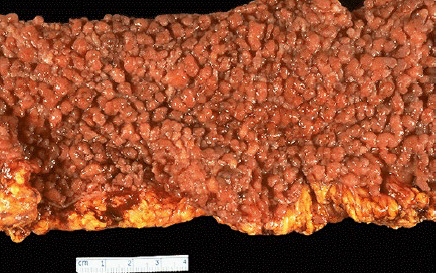 <p>gardner symdrome</p>