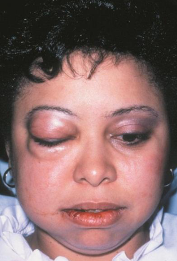 <p>from air forced into subcutaneous or fascia spaces (e.g. blowing an instrument or glass, prolonged extraction while using a handpiece); rapid onset within an hour; facial swelling and erythema, pain dysphagia, dysphonia, vision difficulties, mild fever; TX = AB if infection, most regress spontaneously within 5 days </p>