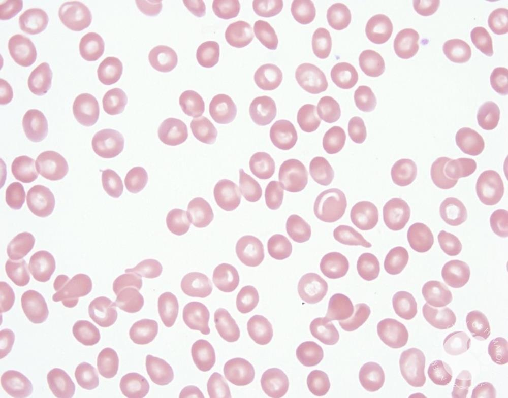 <p>Idiopathic myelofibrosis with myeloid metaplasia; thalassemia syndromes; iron deficiency; drug-induced Heinz body formation; other inclusion-body conditions; megaloblastic processes with macro-teardrops.</p>