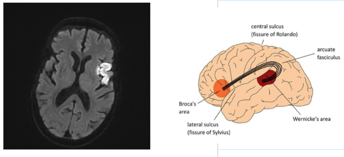 <p><span> Difficulty expressing thoughts<br> May produce nonsense syllables, transpose words and utter structurally incorrect sentences<br> Language comprehension is mostly in tact</span></p><p><span>*Non-Fluent (limited production of speech)</span></p><p><span>*Agrammatism (delete words)</span></p><p><span>*Articulatory problems</span></p><p><span> Paraphasia (replace phoneme or word with another)<br> Automatic speech (overlearned utterances)</span></p>