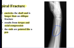 <p>Spiral fracture</p>