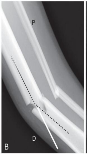 <p>fracture orientation</p>