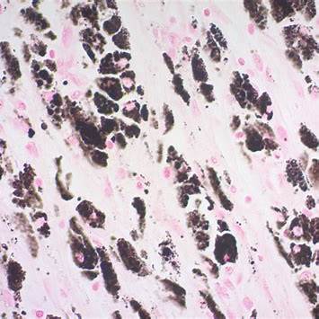 <p><em>Abcam. (n.d.). Fontana–Masson-stained human skin melanoma demonstrating melanin [Photomicrograph].</em></p>