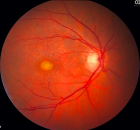 <p>mimics best in adults</p><p>yellow egg yolk of macula</p><p>older patients, better VA</p><p>ERG: normal or slightly decreased</p><p><strong>EOG: barely effected; normal/slight decrease (best has decreased EOG)</strong></p>