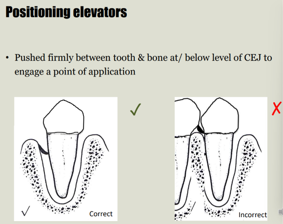 <ul><li><p>Pushed firmly between tooth & bone at/ below level of CEJ to engage a point of application</p></li><li><p>see cross section of the couplands </p></li><li><p>rotating of the instrument - lateral movement of the tooth and widening of the socket </p></li><li><p>rhs - bad as it move the adjaent tooth in opposite direction </p></li><li><p>reember, its used 90 degrees to long axis of the tooth - used mesial to LR6 to move it distally - widens the mesial socket but also distal as the tooth is moving that way, and severs the pdl </p></li></ul><p></p>