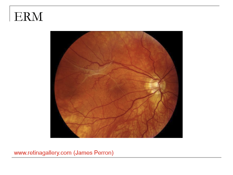 <p>ERM is a fibrocellular proliferation on the inner retinal surface, typically over the macula, causing retinal distortion or traction.<br>Also known as:</p><ul><li><p>Preretinal membrane</p></li><li><p>Macular pucker</p></li><li><p>Surface‑wrinkling retinopathy</p></li><li><p>Cellophane retinopathy</p></li><li><p>Premacular fibroplasia</p></li><li><p>Preretinal gliosis</p></li><li><p>Preretinal macular fibrosis</p></li></ul><p></p>