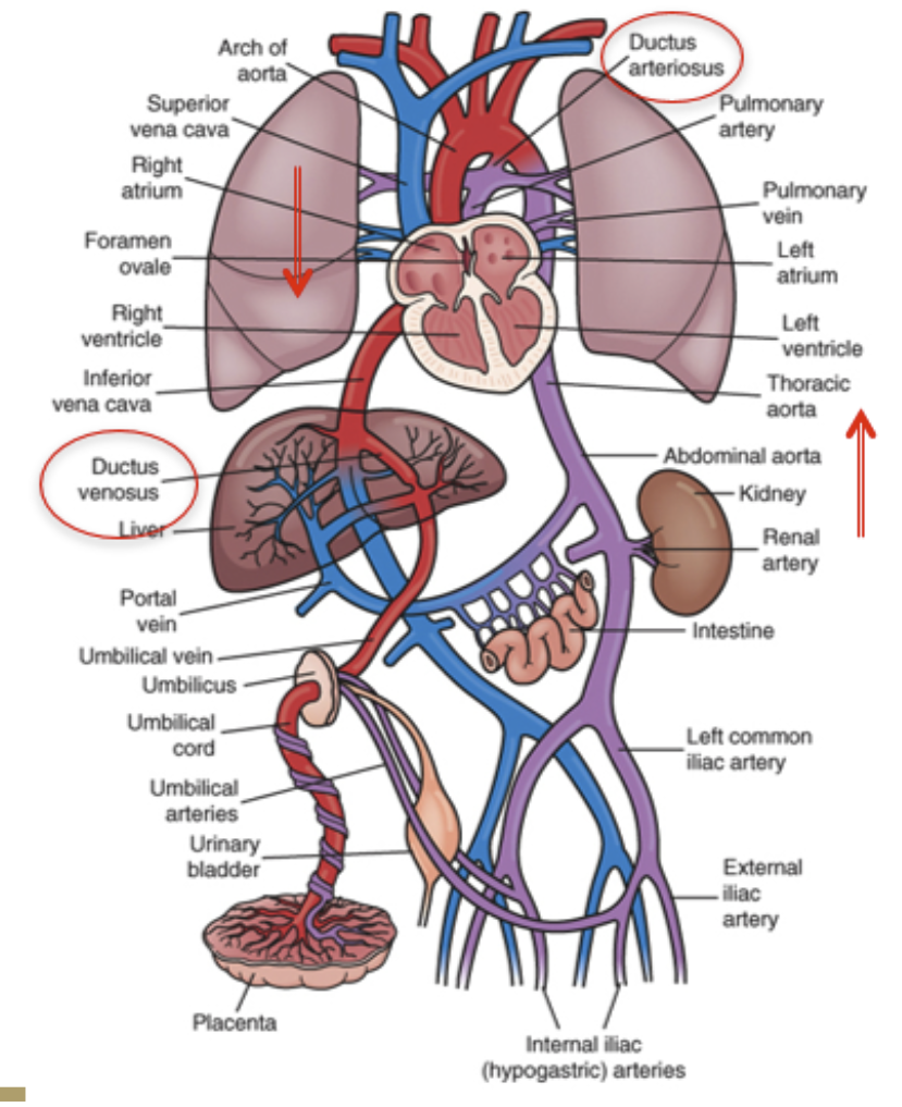 <p>congenital heart defect where the ductus arteriosus doesn’t close after birth</p>