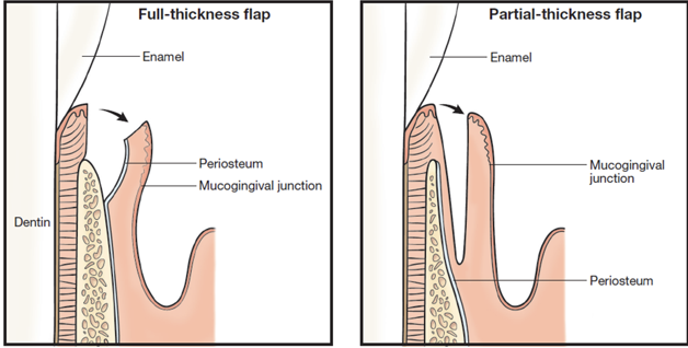 <p><span>Classification of Periodontal Flaps:</span></p>