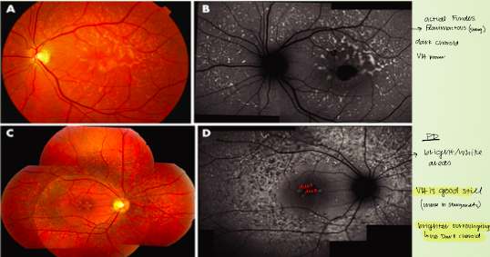<p>actual fundus flavimactous → dark choroid, poor VA</p><p>pattern dystropht → bright white areas of choroid, VA still good, brighter surrounding area with no dark choroid</p><p><strong>ERG: normal/slightly decreased (true fundus flavimaticus/stargardts decrease ERG)</strong></p>