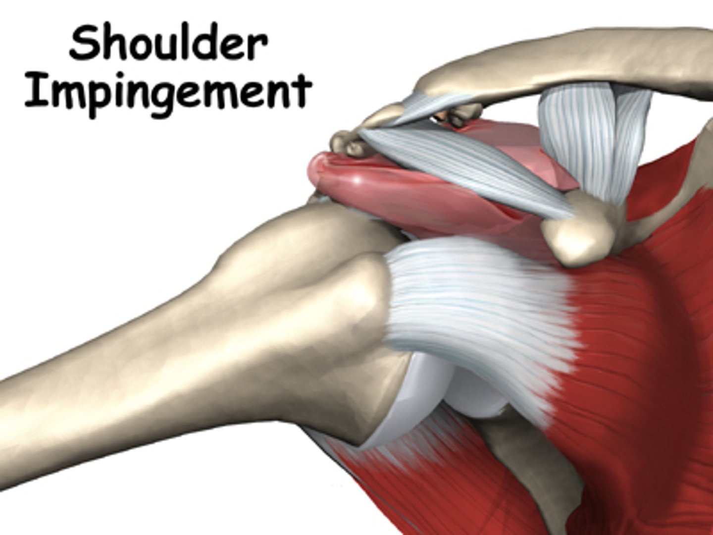<p>compression of the tissue structures between the acromial arch and the humerus</p>