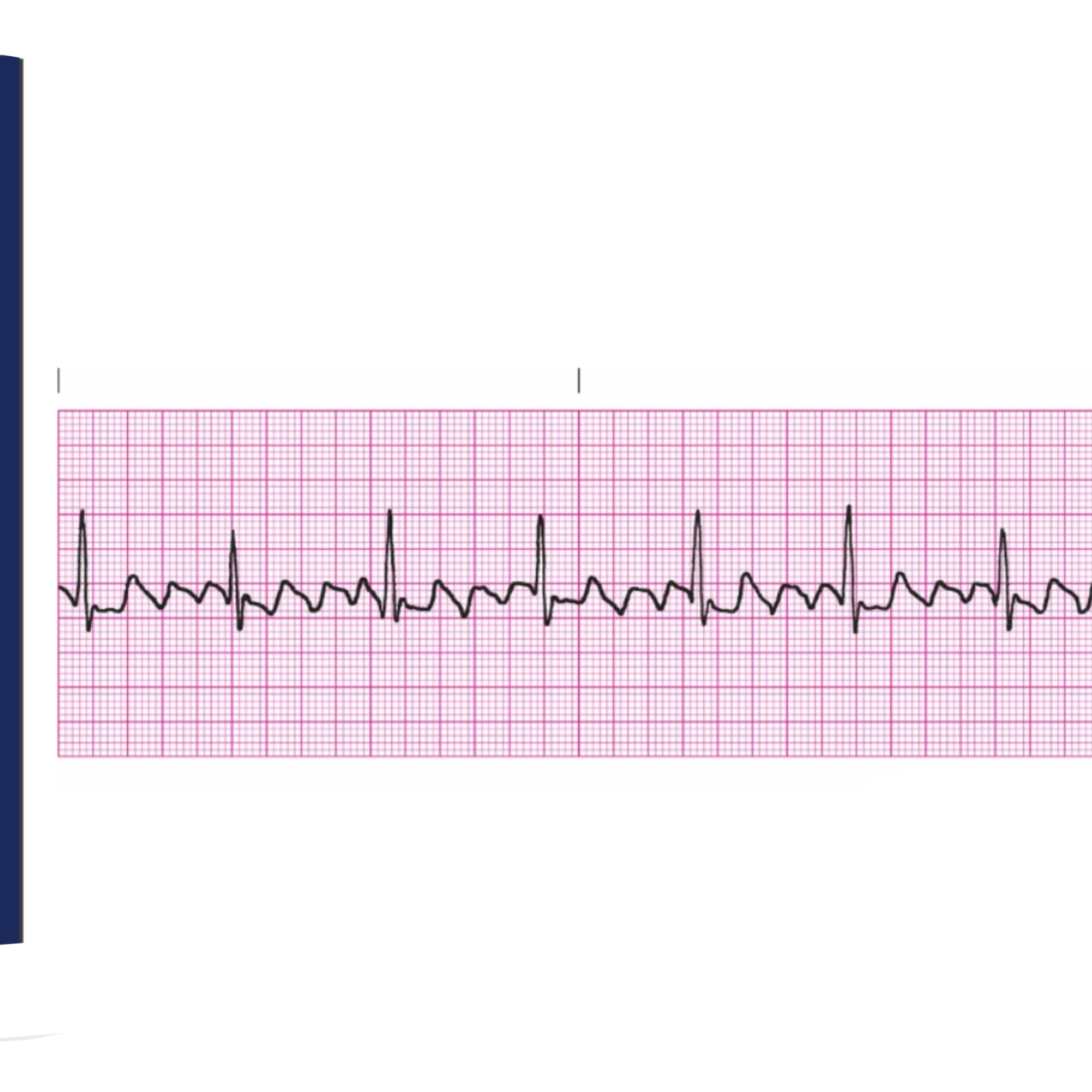 <p>Rules for Atrial Flutter includes</p>
