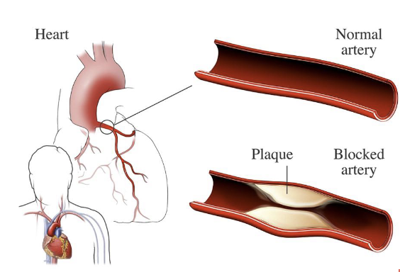<p>narrowing of the blood vessels that supply blood + oxygen to the heart</p><ul><li><p>causing heart attack, chest pain, stroke, affecting heart muscles, valves, or rhythm</p></li><li><p>screening for risk → cholesterol + glucose level, C-reactive protein presence, BP, health history, PAD</p><ul><li><p>screening starts at 20 for BP, fasting lipoprotein profile, body weight</p></li><li><p>screening at age 45 for blood glucose every 3 years</p></li></ul></li></ul><p></p>