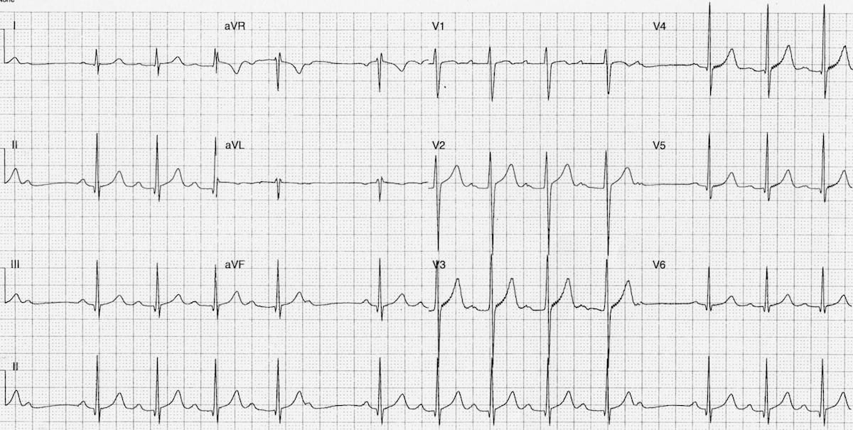 <p>What does this EKG show?</p>