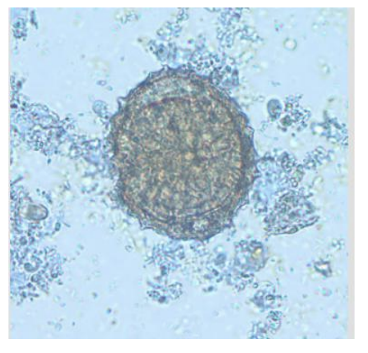 <p>pollen grain in stool that may look like</p>