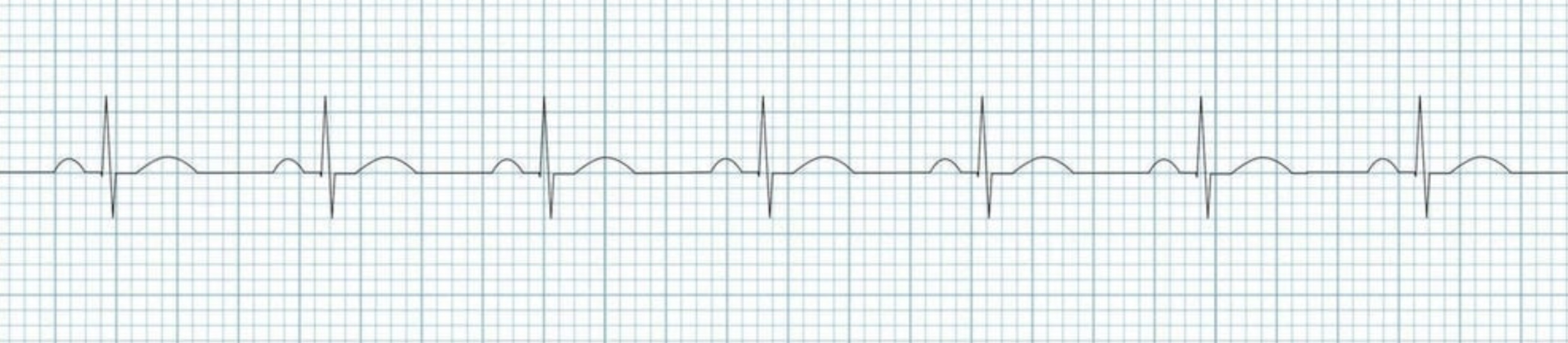 <p>What rhythm/abnormality is seen below?</p>