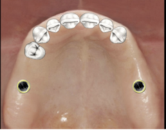 <p>(Dots are implants)</p>