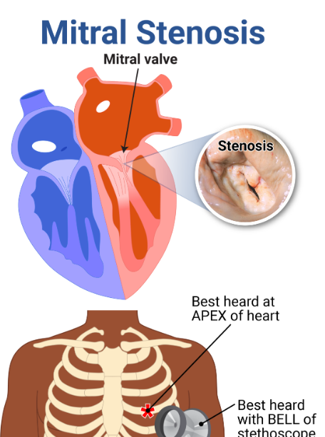<p>mitral stenosis description</p>