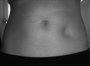 <ul><li><p><span>loss of fat under the skin</span></p></li></ul><ul><li><p><span>the area looks sunken or dented</span></p></li></ul><p></p>