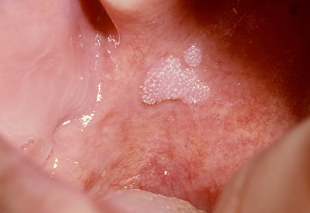 <p>the lesion is multiple which of the following would be the MOST LIKELY diagnosis: </p><p>condyloma acuminatum </p><p>squamous papilloma </p><p>neurofibroma </p><p>verruca vulgaris </p>