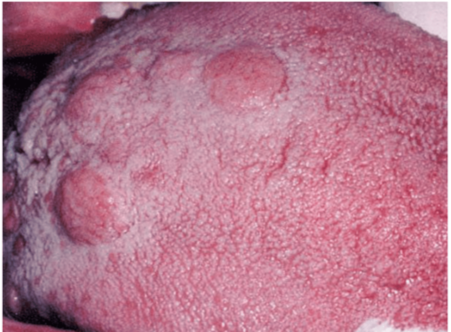 <p>- wart-like lesions in genital area. rash resolves spontaneously within 2-6 weeks.</p>
