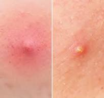 <p>Small, raised bump on the skin that is less than one cm in diameter.</p><ul><li><p>Insect bites and chickenpox are examples.<br></p></li></ul><p></p>