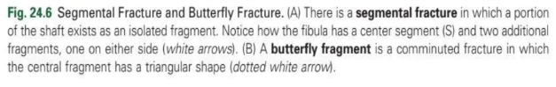 <p>butterfly fracture - comminuted fracture</p>