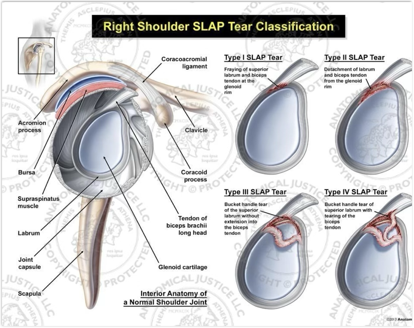 <p>SLAP lesion symptoms &amp; treatment </p>
