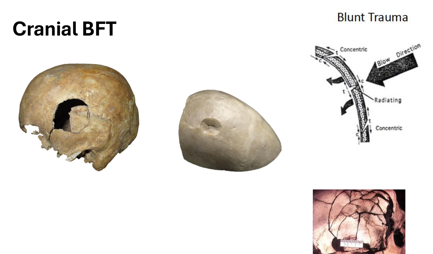 <ul><li><p>Often associated with a violent event</p></li><li><p>Caused by large, heavy objects with a blunt edge striking the body</p><ul><li><p>i.e. baseball bat, club, hockey stick</p></li></ul></li><li><p>Different areas of bones will react differently depending on the structural integrity of the bone</p><ul><li><p>Also depends on severity of hit</p></li></ul></li><li><p>Bone collapses and shatters</p></li></ul><p></p>