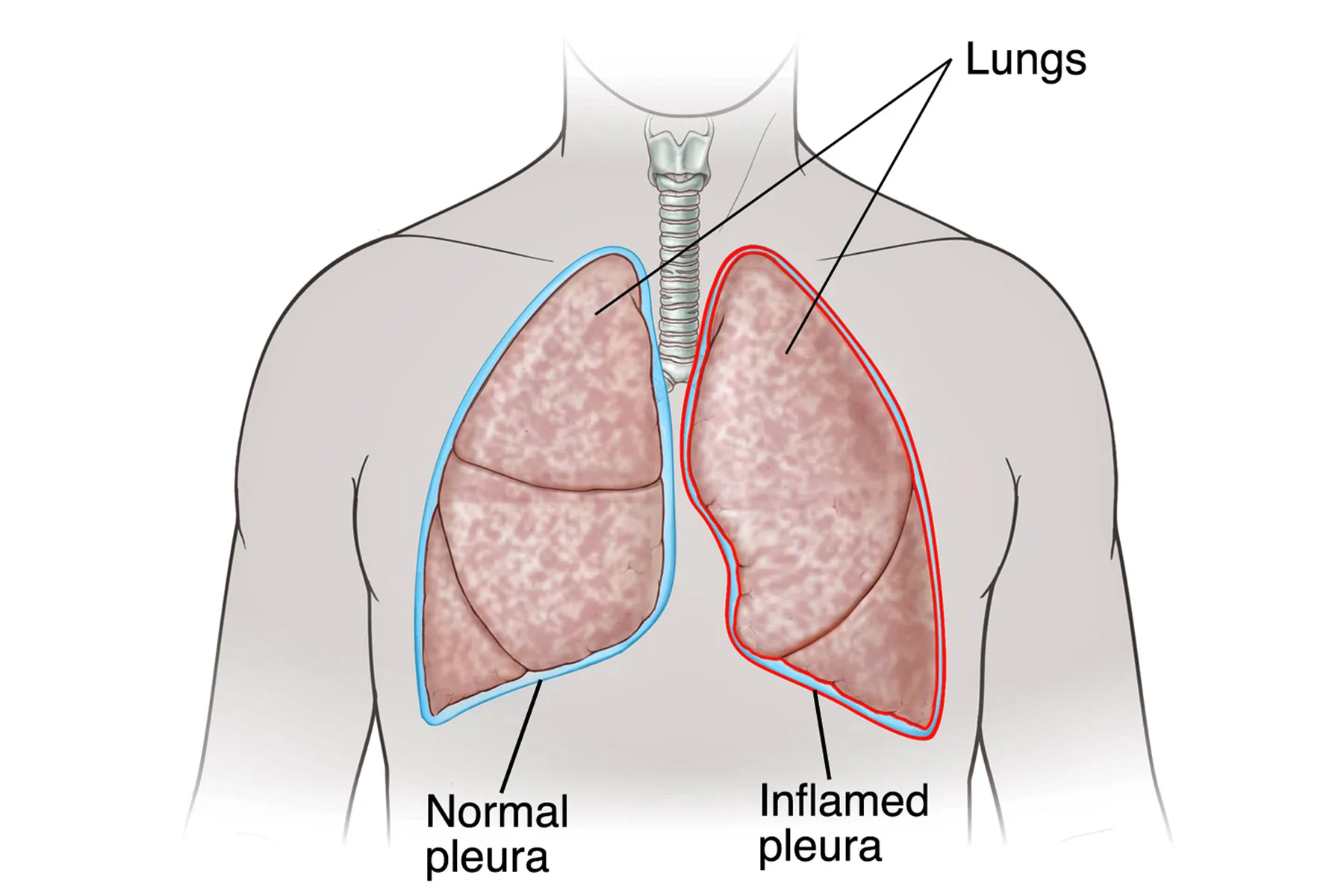 <p>Pleura </p>