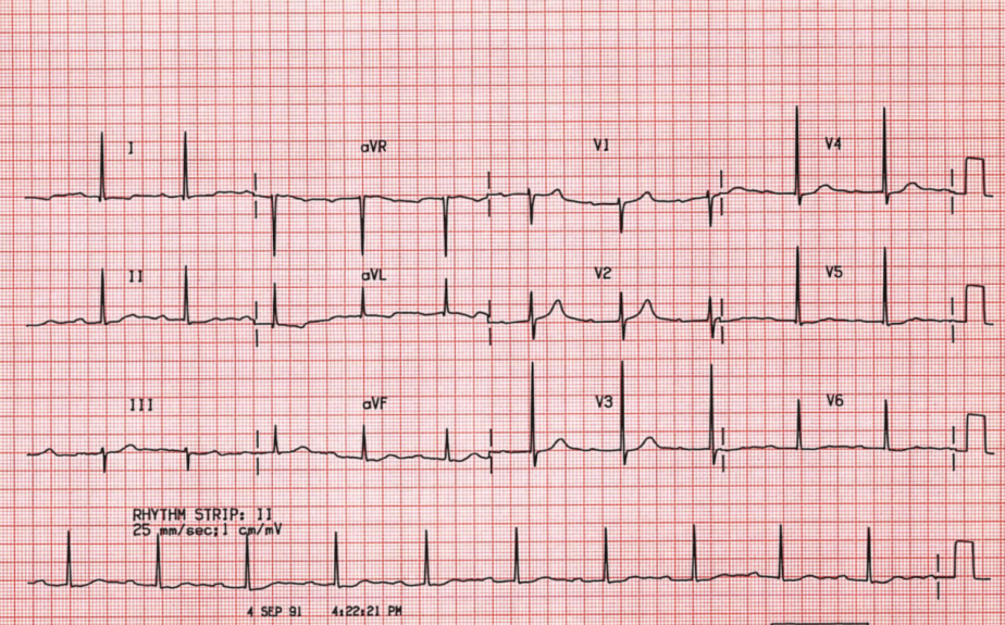 <p>What does this EKG show? </p>