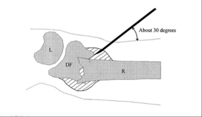 <p>Haematoma block to numb the wrist and align it better  (yh a needle’s inserted)</p>