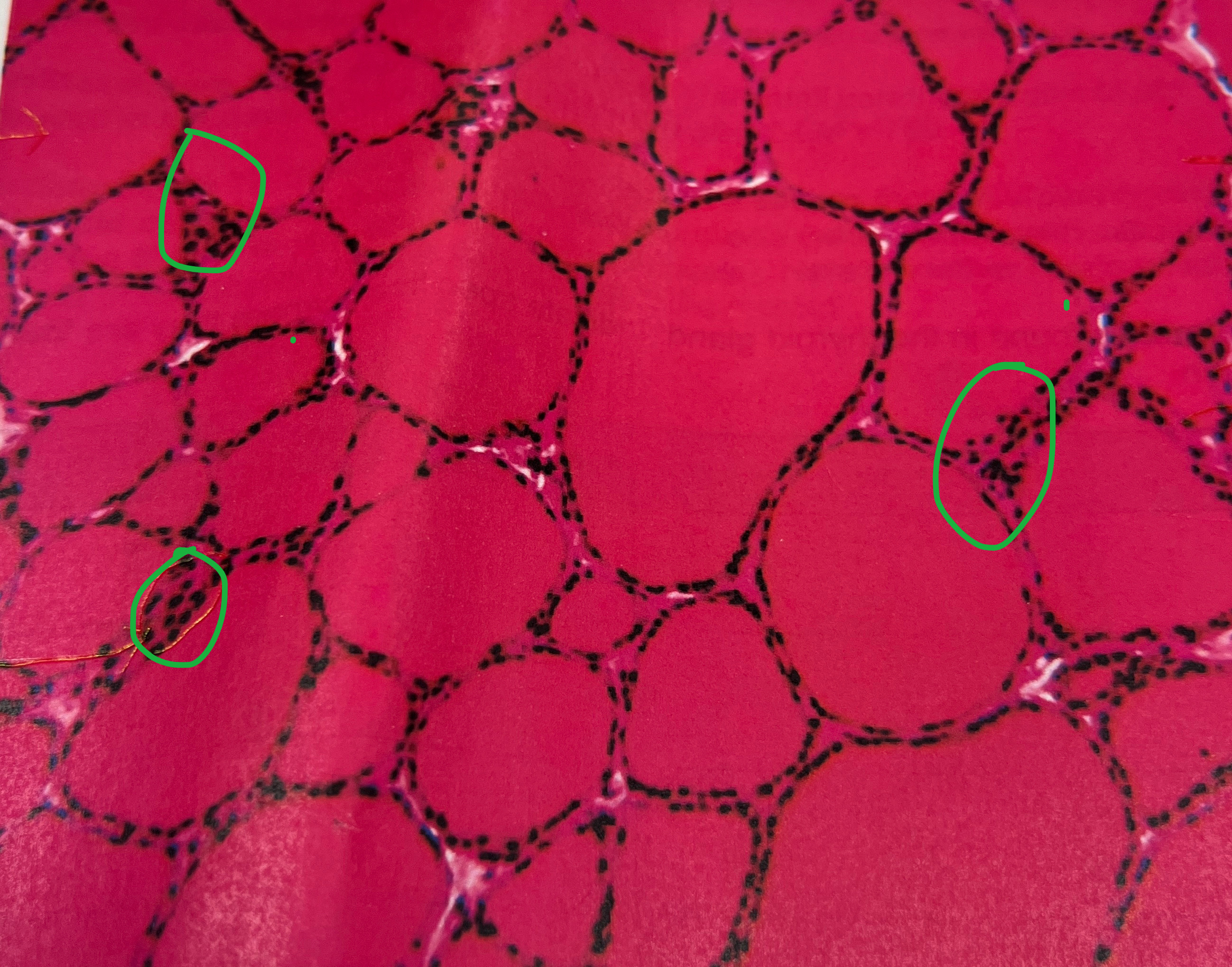 <p>What are the cookie patches called in the thyroid gland?</p>