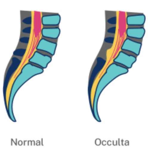 <p>Has a small gap in the vertebrae, but the spinal cord and nerves stay inside</p>