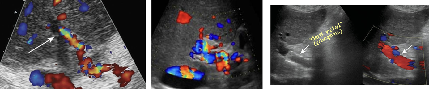 <ul><li><p>fresh/new thrombus appear echogenic; old thrombus appears anechoic</p></li><li><p>if thrombus has no Doppler flow, it is occlusive</p><ul><li><p>occluded PV → cavernous transformation</p></li></ul></li><li><p>stent placement</p></li></ul><p></p>