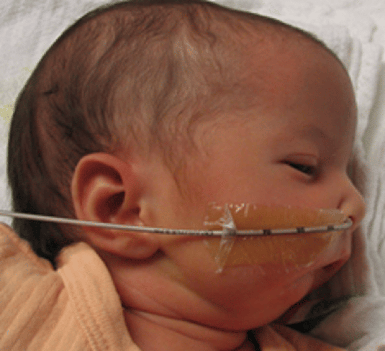 <p>part of Pierre Robin Syndrome which also includes glossoptosis (falling backwards of the tongue) and a Cleft palate. </p>