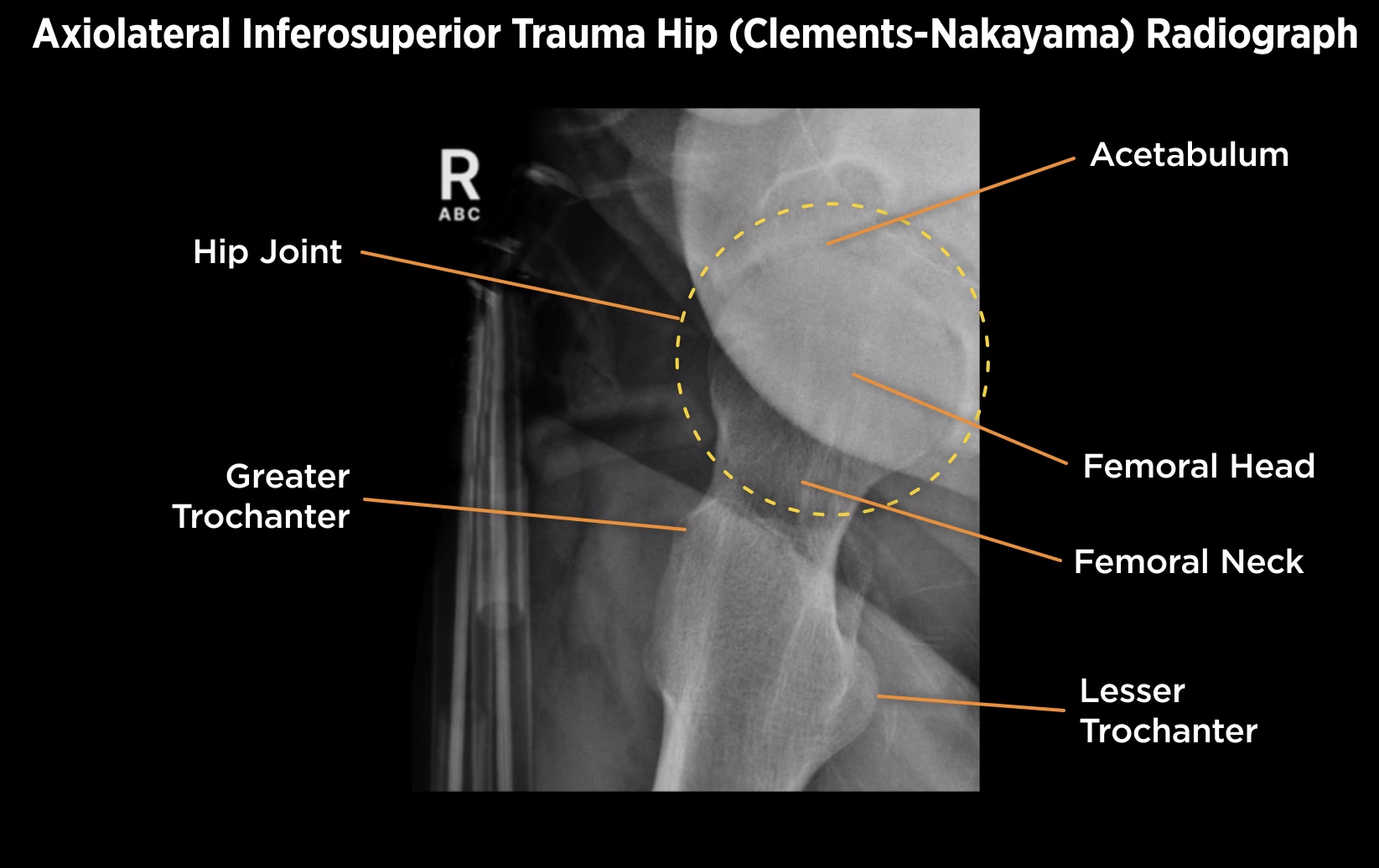 <p>What is the angle for the Clements-Nakayama View?</p>