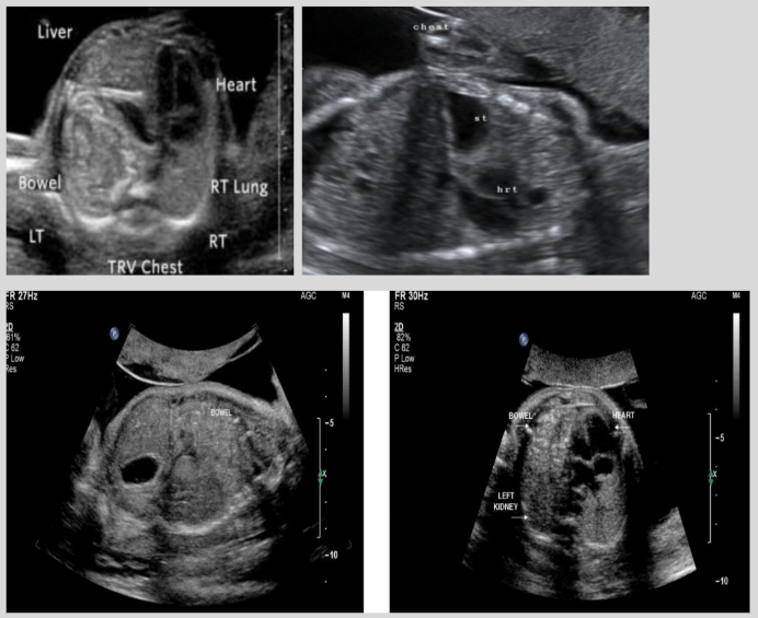 <ul><li><p><span style="background-color: transparent;">Herniation of stomach/bowel/spleen into thoracic cavity through diaphragmatic defect</span></p></li><li><p><span style="background-color: transparent;">Result of incomplete fusion of diaphragmatic structure at 6-10 menstrual weeks</span></p></li><li><p><span style="background-color: transparent;">Most common: LT-sided herniation (95%)</span></p></li></ul><p></p>