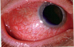 <p>Rheumatoid Arthritis</p>