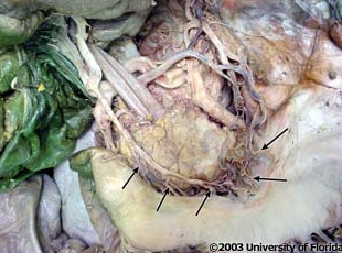 <p>which arteries are being indicated to in the image? context: left lobe of liver has been removed</p>