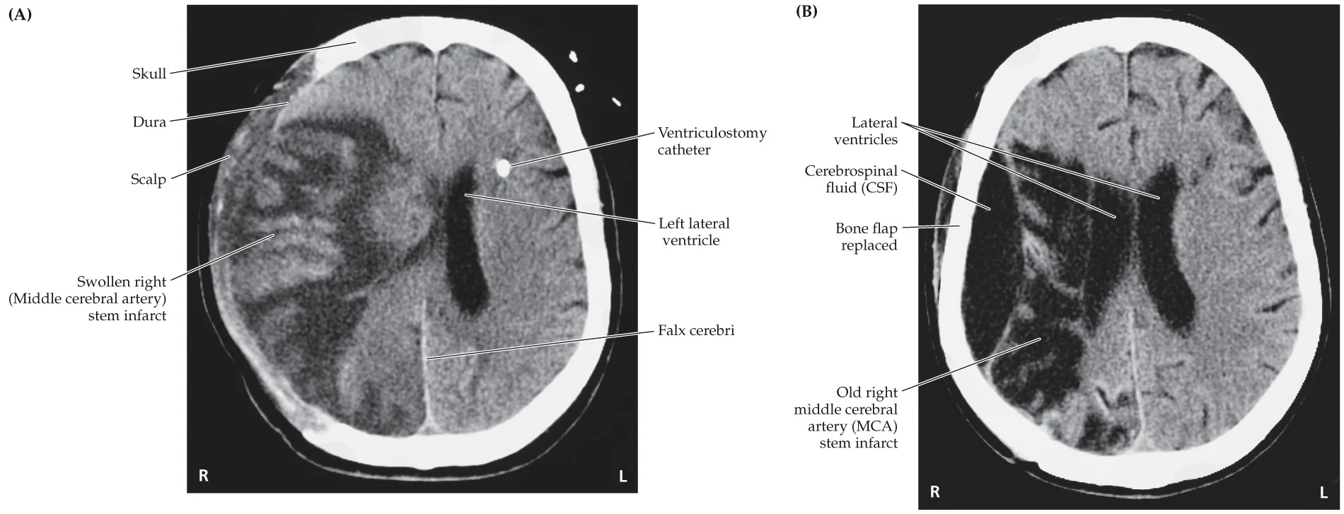 <p>Right MCA infarct, large right cerebral cortex infarct </p>