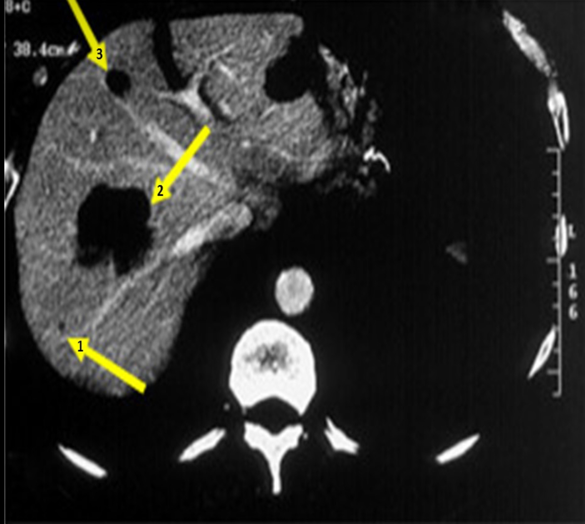 <p>A patient is referred for an abdominal ultrasound due to abnormal CT scan. Refer to the image to determine where will you find the mass marked with #3?</p>