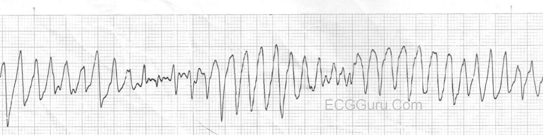 <p>Rate: 200-250 </p><p>Regularity: irregular </p><p>QRS width is variable </p>