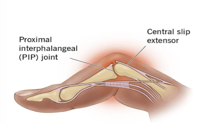 <p>Boutonniere Deformity </p>