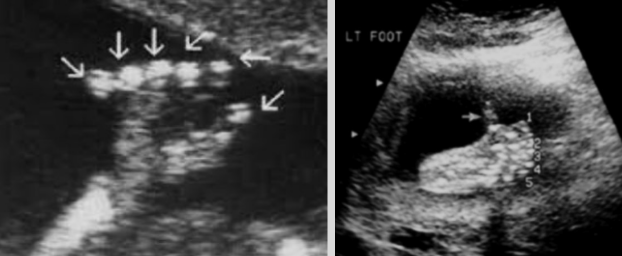 <ul><li><p><span style="background-color: transparent;">Presence of extra digits on the fetal hands or feet</span></p></li><li><p><span style="background-color: transparent;">One of the most common hand anomalies</span></p></li><li><p><span style="background-color: transparent;">Can be an isolated finding or part of a syndrome</span></p><ul><li><p><span style="background-color: transparent;">Short polydactyly syndrome, asphyxiating thoracic dysplasia, trisomy 13, trisomy 18, and trisomy 21</span></p></li></ul></li></ul><p></p>