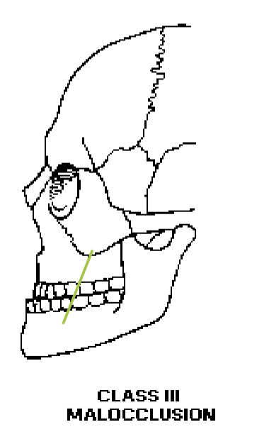 <p>Class III Malocclusion </p>