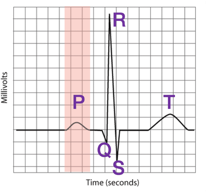 <p>waves = P, T, QRS</p><ul><li><p>sums up all electrical events in heart b/c body fluids conduct APs </p></li><li><p>from surface of skin → 10 sticky electrode disks placed on diff chest/arm/legs </p></li></ul><ul><li><p>THUS → give 12 views of heart electrical activity from diff areas </p></li></ul><div data-type="horizontalRule"><hr></div><p>has 3 waves →</p><ol><li><p>P wave = depolarization ARTIA </p></li><li><p>QRS wave = depolarization VENTRICLES</p></li><li><p>T wave = REPOLARIZATION ventricles </p></li></ol><p></p>