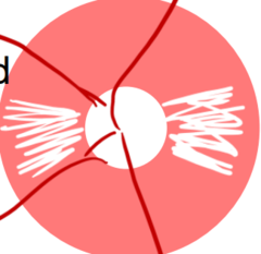 <p>What does bow tie or band atrophy neuro retinal rim pallor indicate?</p>