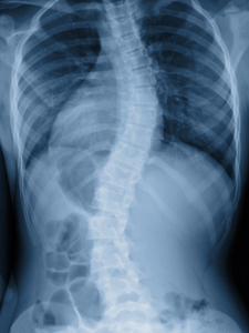<p>-osis</p>