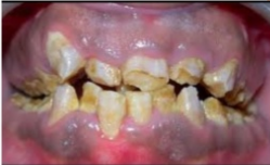 <p><span>Radiographic features: Density of enamel and dentin are similar.</span></p>