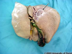 <p>what impression is being highlighted on the liver?</p>